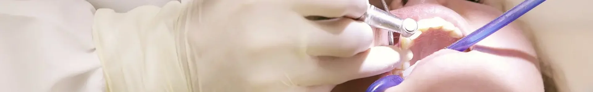 Tooth Removal Treatment